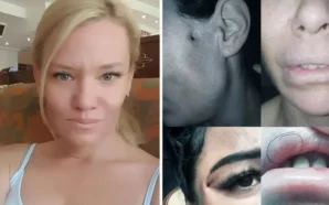 Лікар спотворила моє обличчя: У Румунії засудили косметолога з Молдови